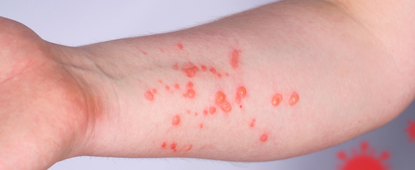 Bệnh đậu mùa khỉ là gì? Nguyên nhân, dấu hiệu và phòng ngừa