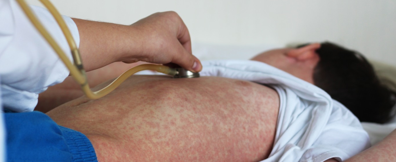 sốt phát ban và sởi
