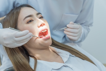 Nhổ răng khôn có được bảo hiểm chi trả không?