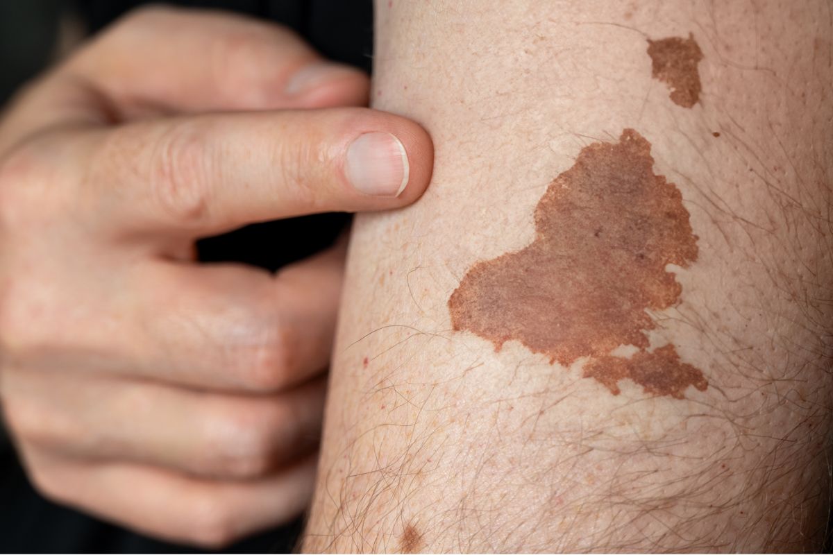 dau-hieu-ung-thu-da-nhan-biet-som-dieu-tri-kip-thoi-1200x800-1