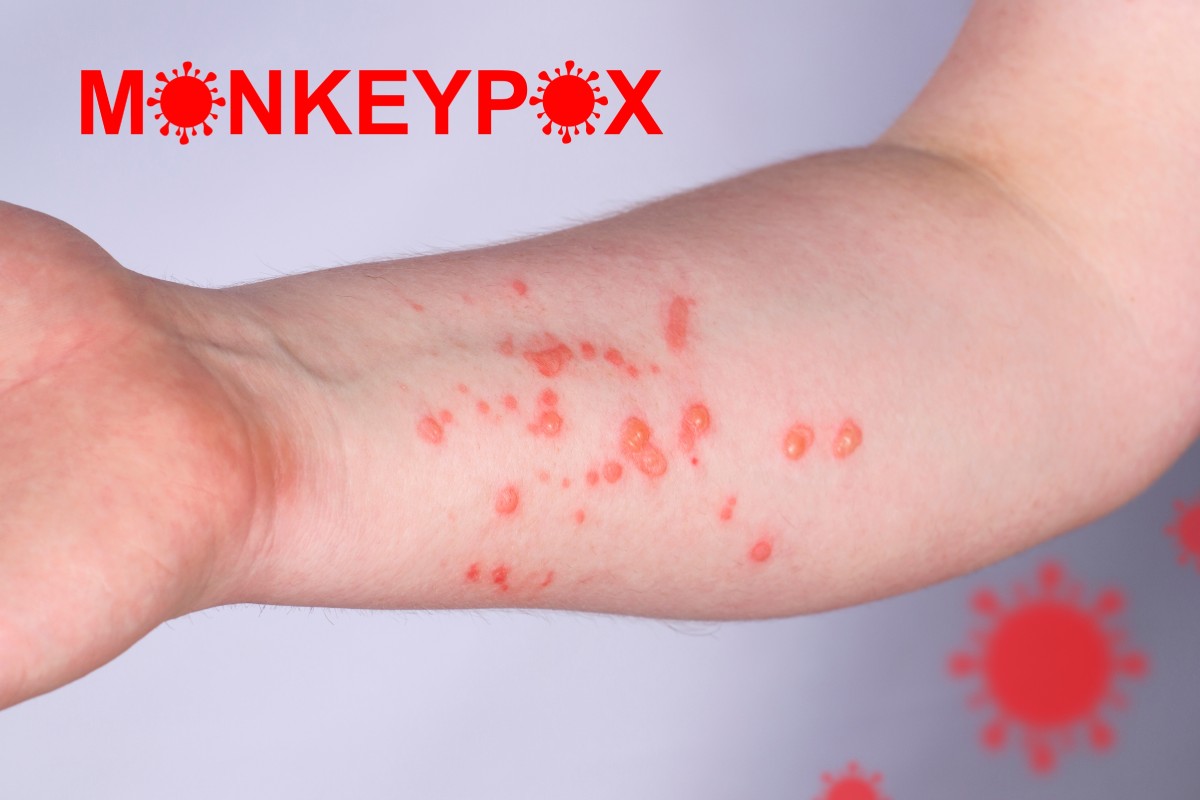 benh-dau-mua-khi-ai-de-mac-phai-va-phong-ngua-the-nao-1200x800-1