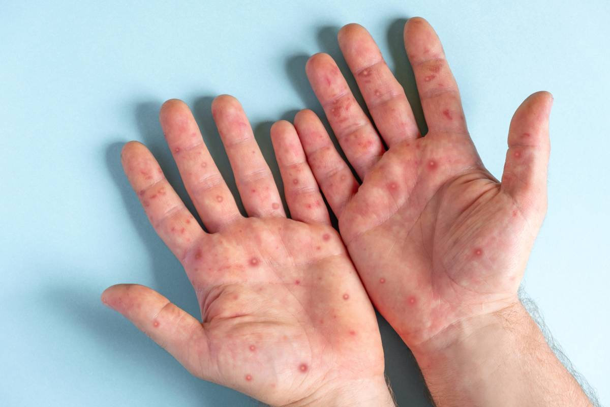 benh-dau-mua-khi-ai-de-mac-phai-va-phong-ngua-the-nao-1200x800-4.